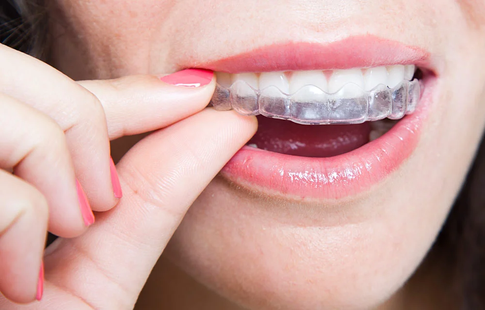 invisalign-clear-aligners.jpg