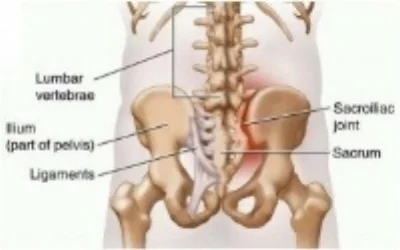 strain of saco-iliac joint