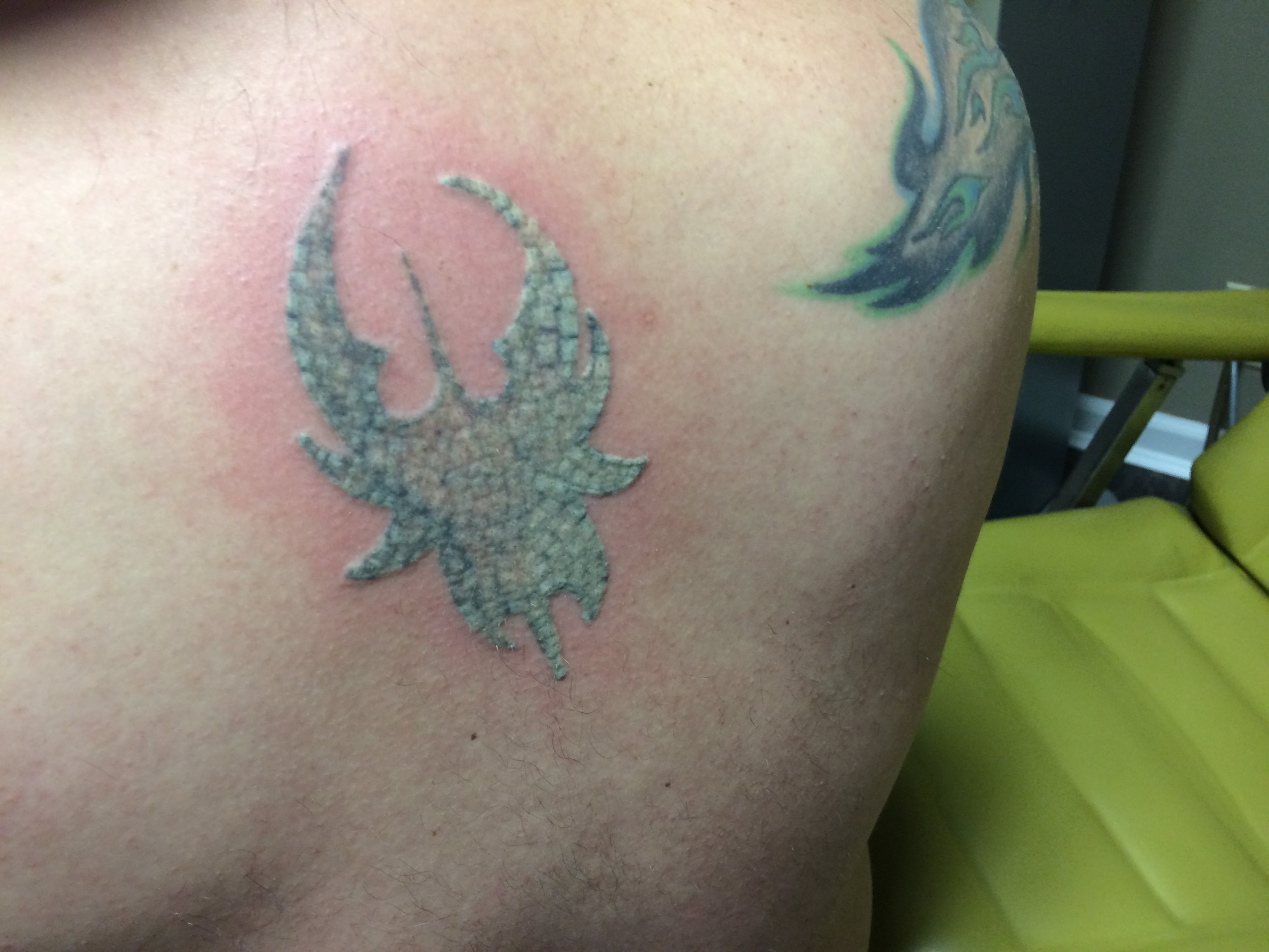 Tattoo after one laser treatment