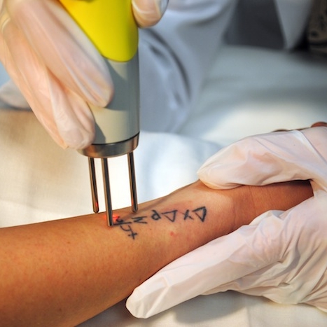 Tattoo Removal Ink