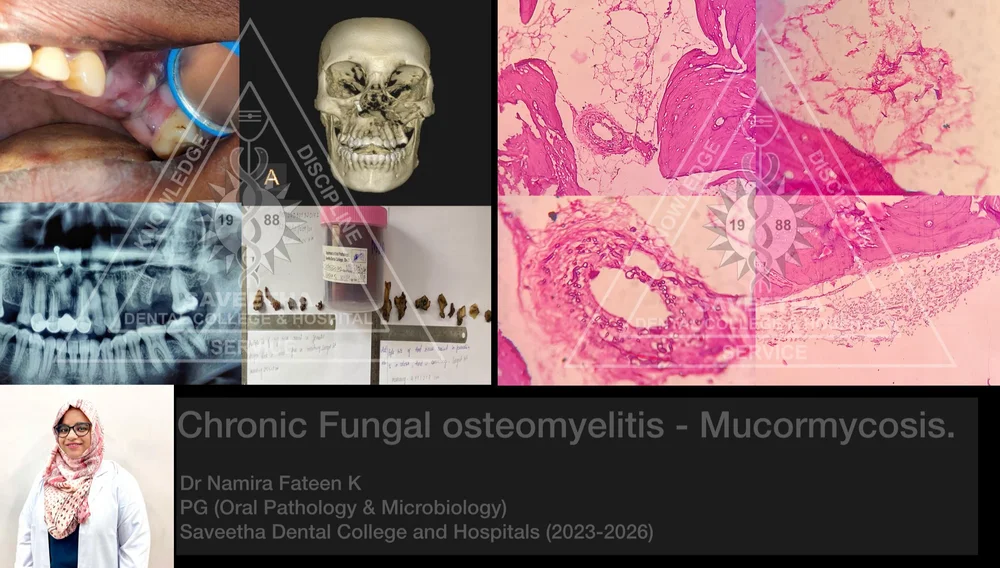 Chronic fungal osteomyelitis Mucormycosis — ORAL PATHOLOGYSAVEETHA