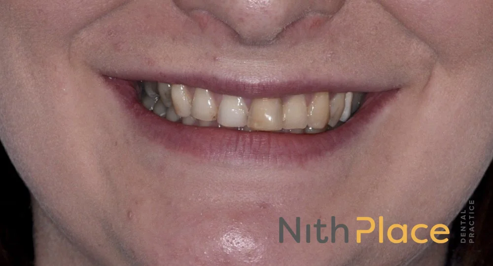 Nith Place Dental Veneers Before_3bd.jpeg