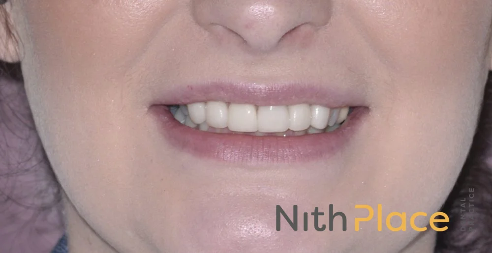 Nith Place Dental Veneers After_3bd.jpeg
