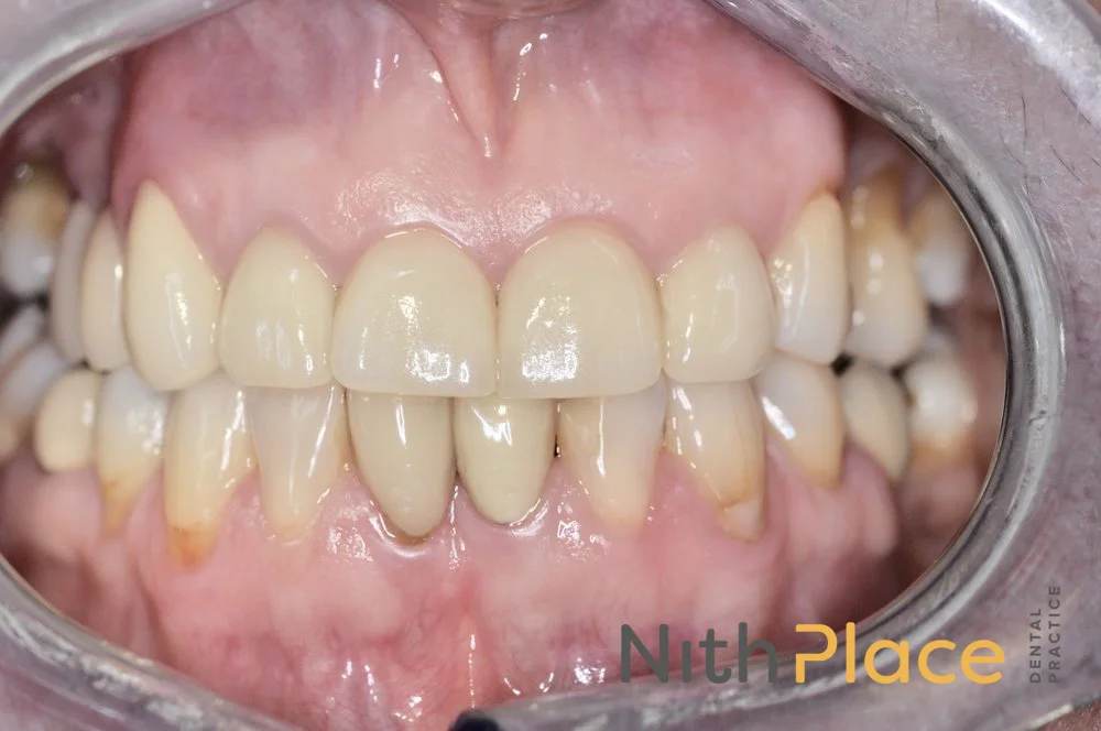 Nith+Plance+dental+crowns+and+veneers+after31e.jpeg