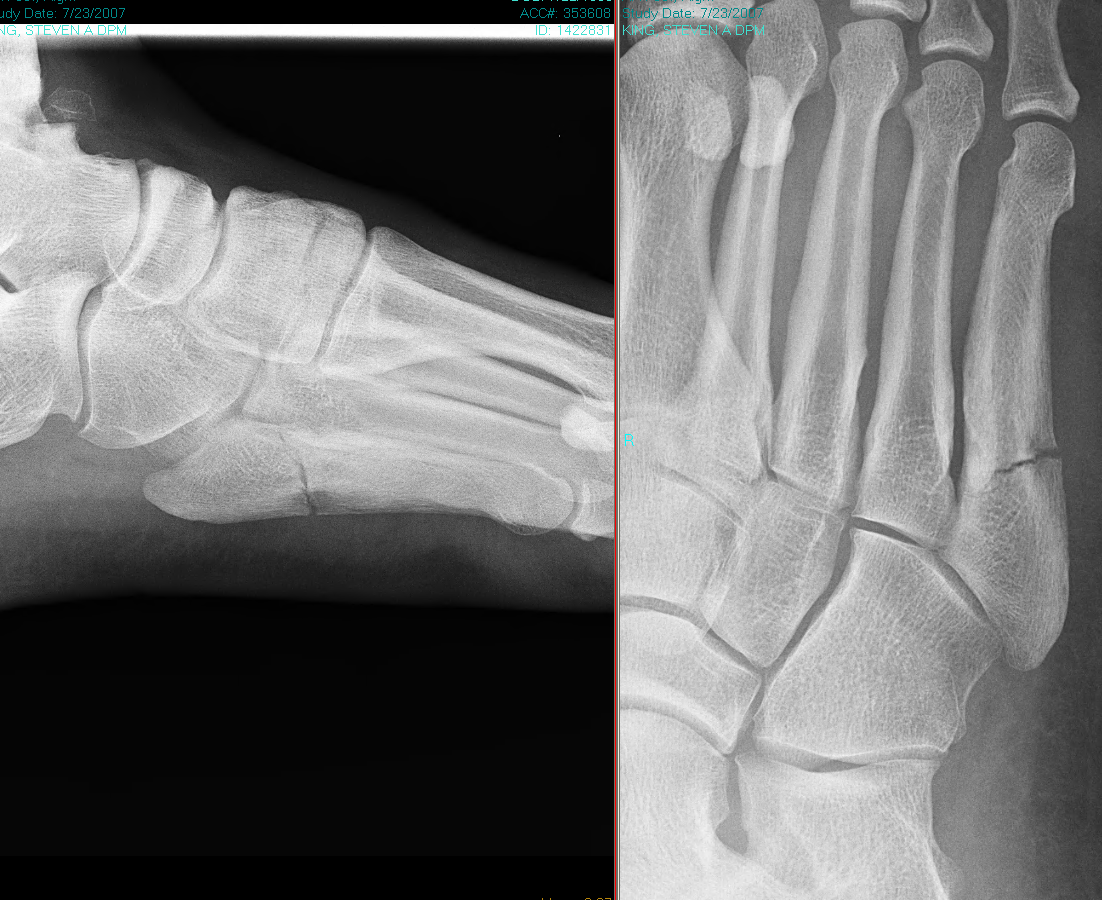 Sometime we just need a break to be successful… Dr. King suffered this 5th Metatarsal Jone's fracture while playing competitive adult recreational sports. Surgery was considered (a 6.5 canulated screw up the bone shaft) but ultimately was not needed when the new advanced Kingetics orthotic system helped heal and protect his broken foot. Dr. King used this setback as a spring board to become Co-Principle Investigator for Small Business Innovation Research contract # A11-109, "Advanced Composite Insoles for the Reduction of Stress Fractures," sponsored and funded by the United States Department of Defense and Army Medical Research and Materials Command. The boot-orthotic they produced from this research resulted in a reduction of combat boot weight by 30% , improvement against puncture by 300-1000%, and would not start on fire with horizontal and vertical flame testing. The Department of Defense responded in a rejection letter afterward stating "There is limited commercial potential for this application in the military." There has been no further "government" funded research since.