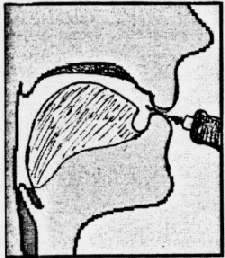Fig. 1: Tongue in Normal Position