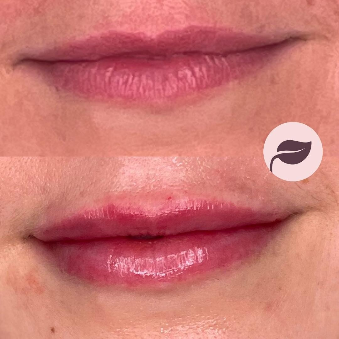 LIP Filler ・Before and immediately following 1ml of premium hylaronic acid filler. My client is after just some subtle added volume in both the top and bottom lip. There is usually some swelling for 3-5 days following this treatment. Thanks so much to my client for allowing me to share her before and afters 😘 👄 🍂