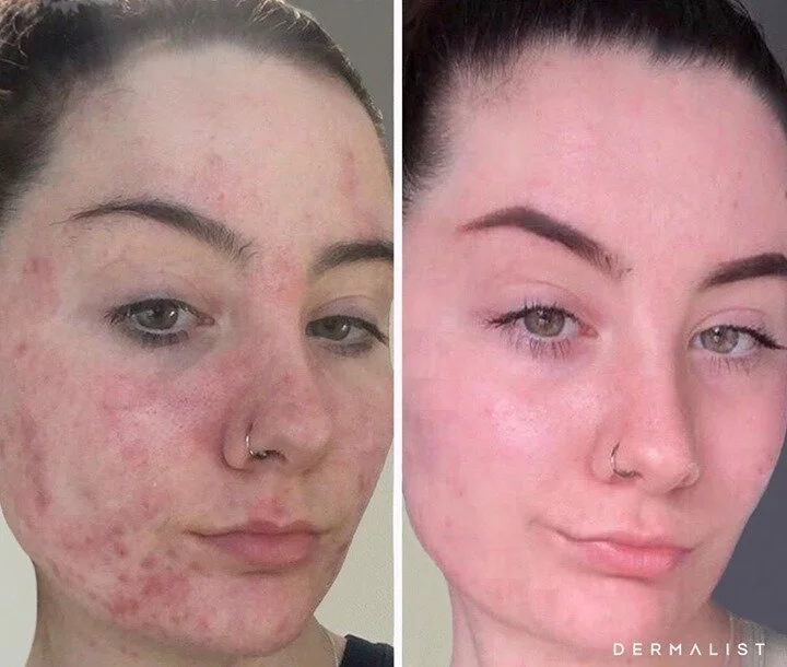 BEFORE and AFTERS after using Dermalist skin care! The results are unbelievable. This client was only using the range (of 3 products!) for only 28 days. The products have AHA's, Anti-inflammatories and Anti-Oxidants to improve overall skin health. The starting kit or Radience Essential Kit retails for only $69. 😍 🍂