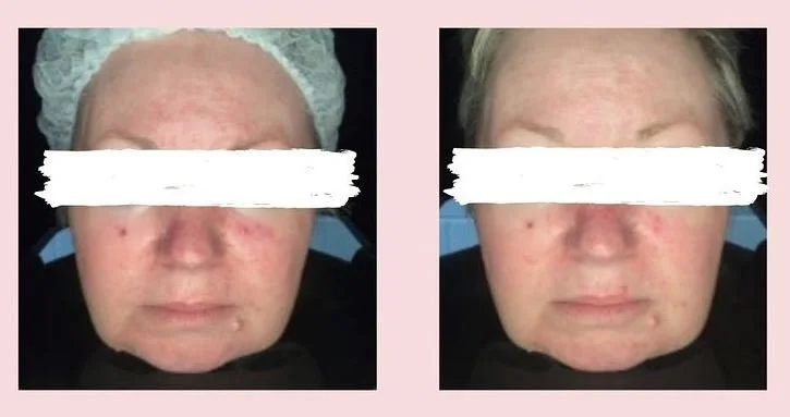 Our Rosacea Treatment: LED Light Therapy