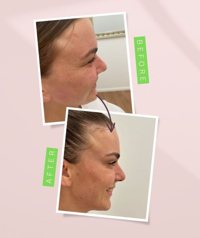 Cosmetic injections results for crows feet before and after anti-ageing treatment at New Age Skin Care Wagga Wagga