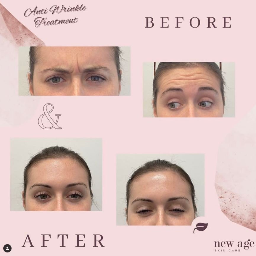 Cosmetic injections results for forehead lines before and after anti-ageing treatment at New Age Skin Care Wagga Wagga