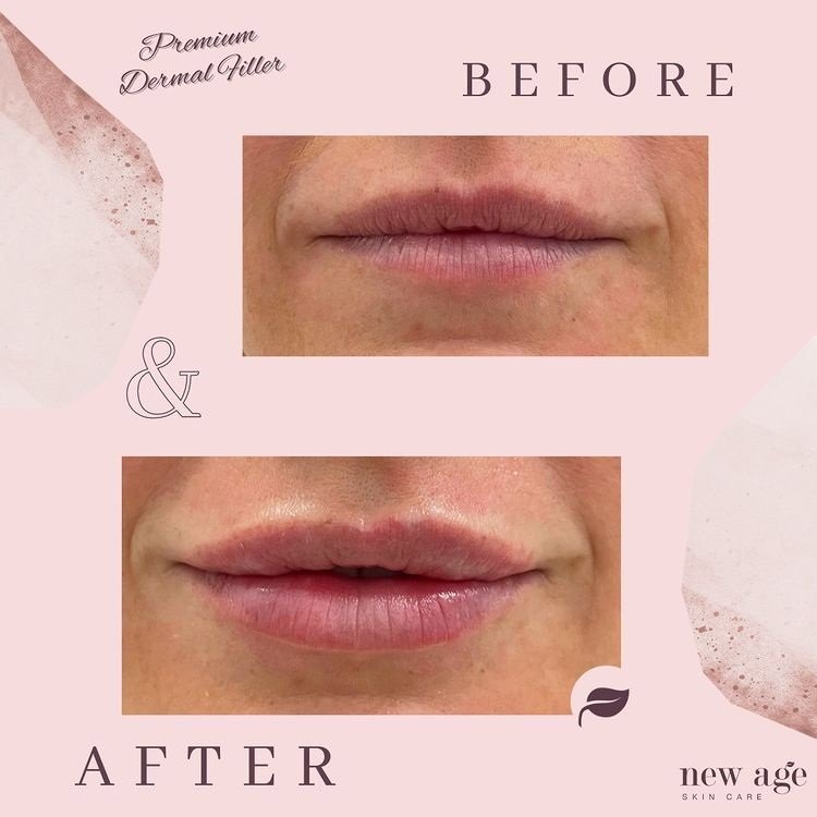 Cosmetic injections results for lips before and after dermal filler treatment at New Age Skin Care Wagga Wagga
