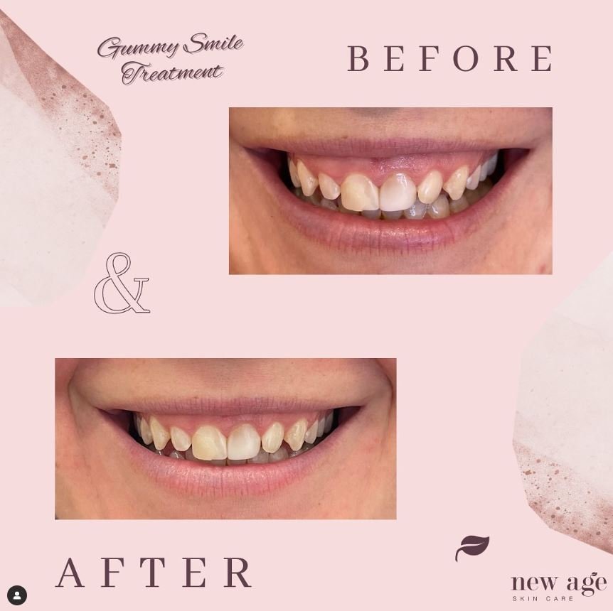 Cosmetic injections results for gummy smile before and after treatment at New Age Skin Care Wagga Wagga