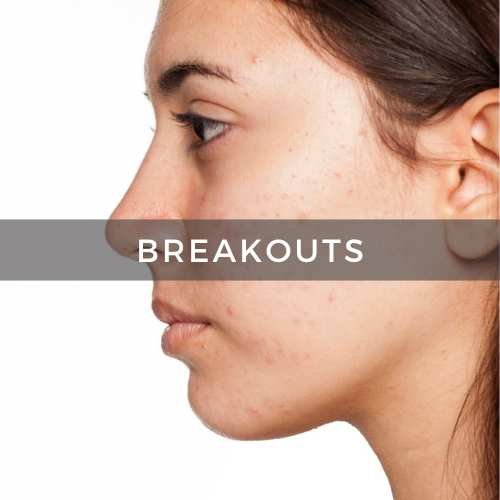 Acne, breakouts & oily skin