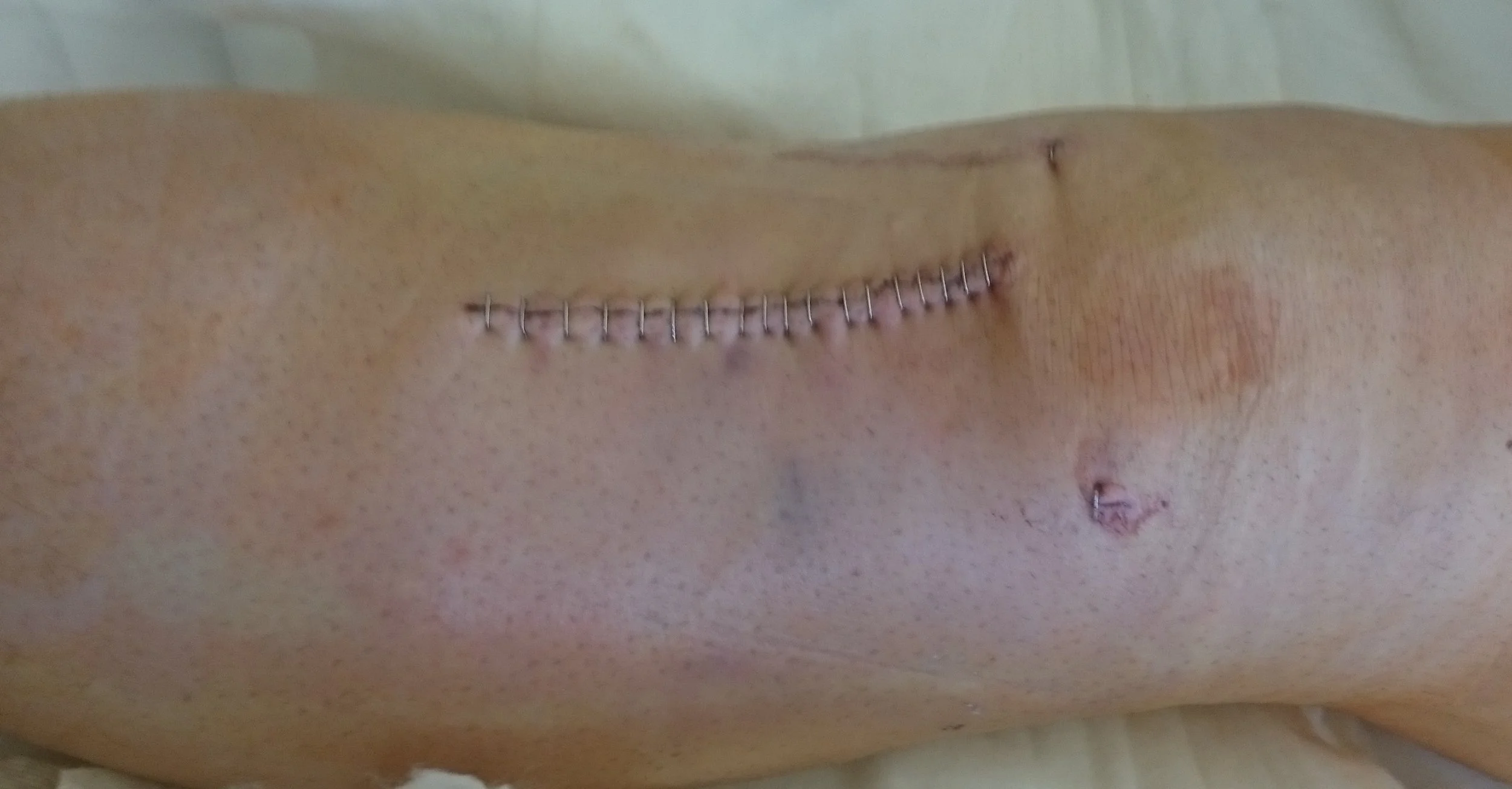 This is how the knee and just under the knee looked the day after the surgery.