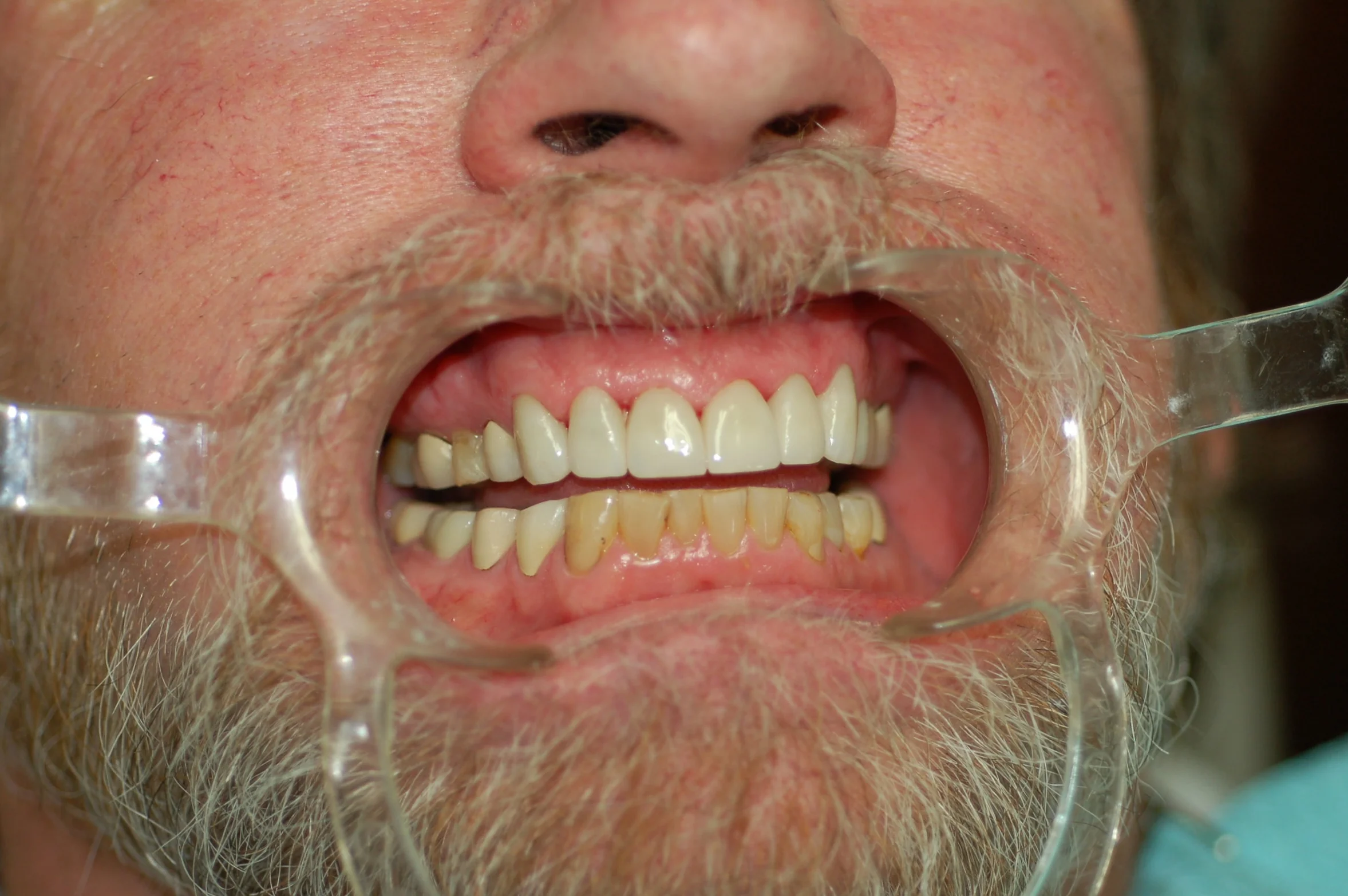 Beautiful new crowns on the upper teeth give him a reason to smile!