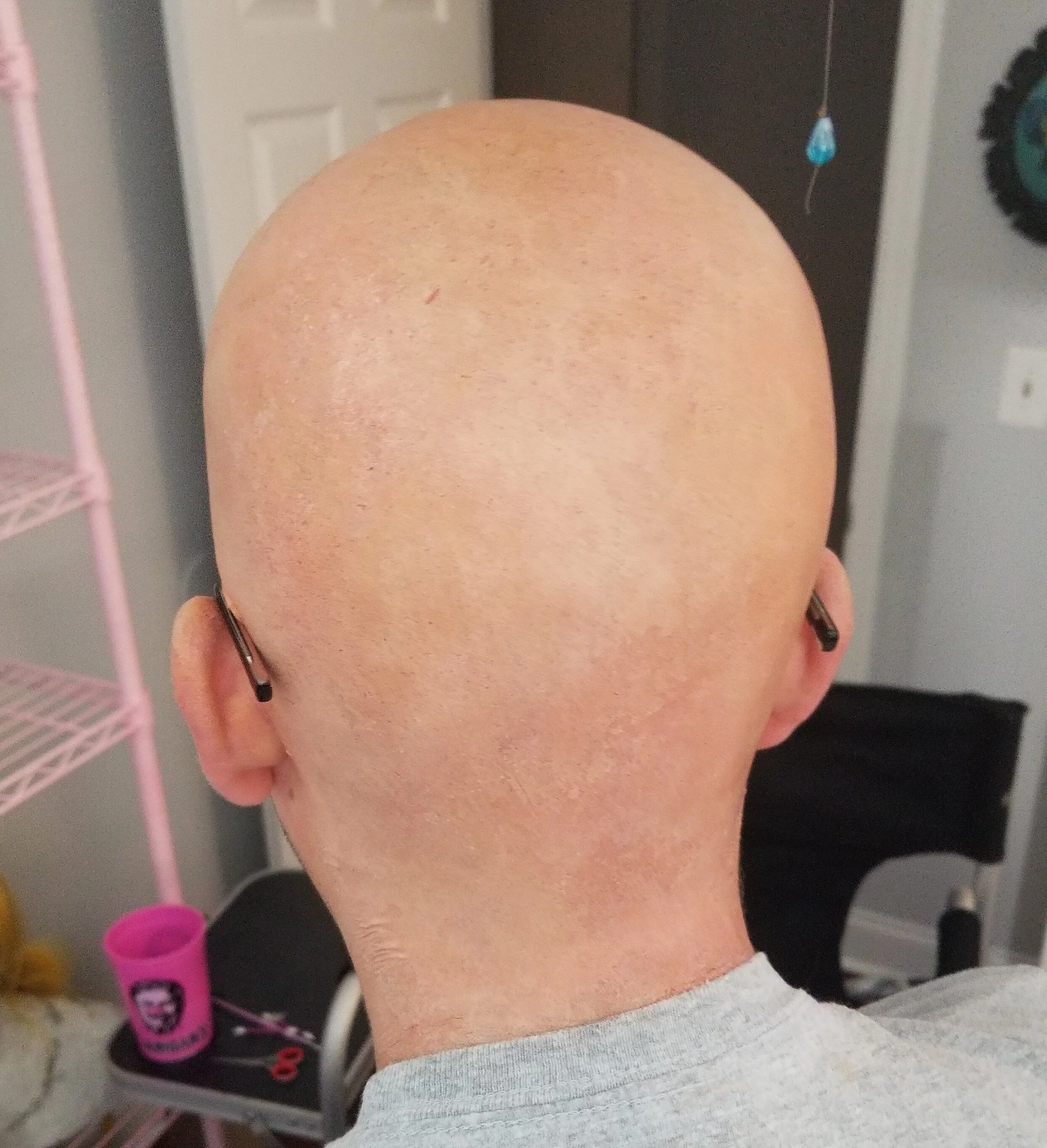 Baldcap