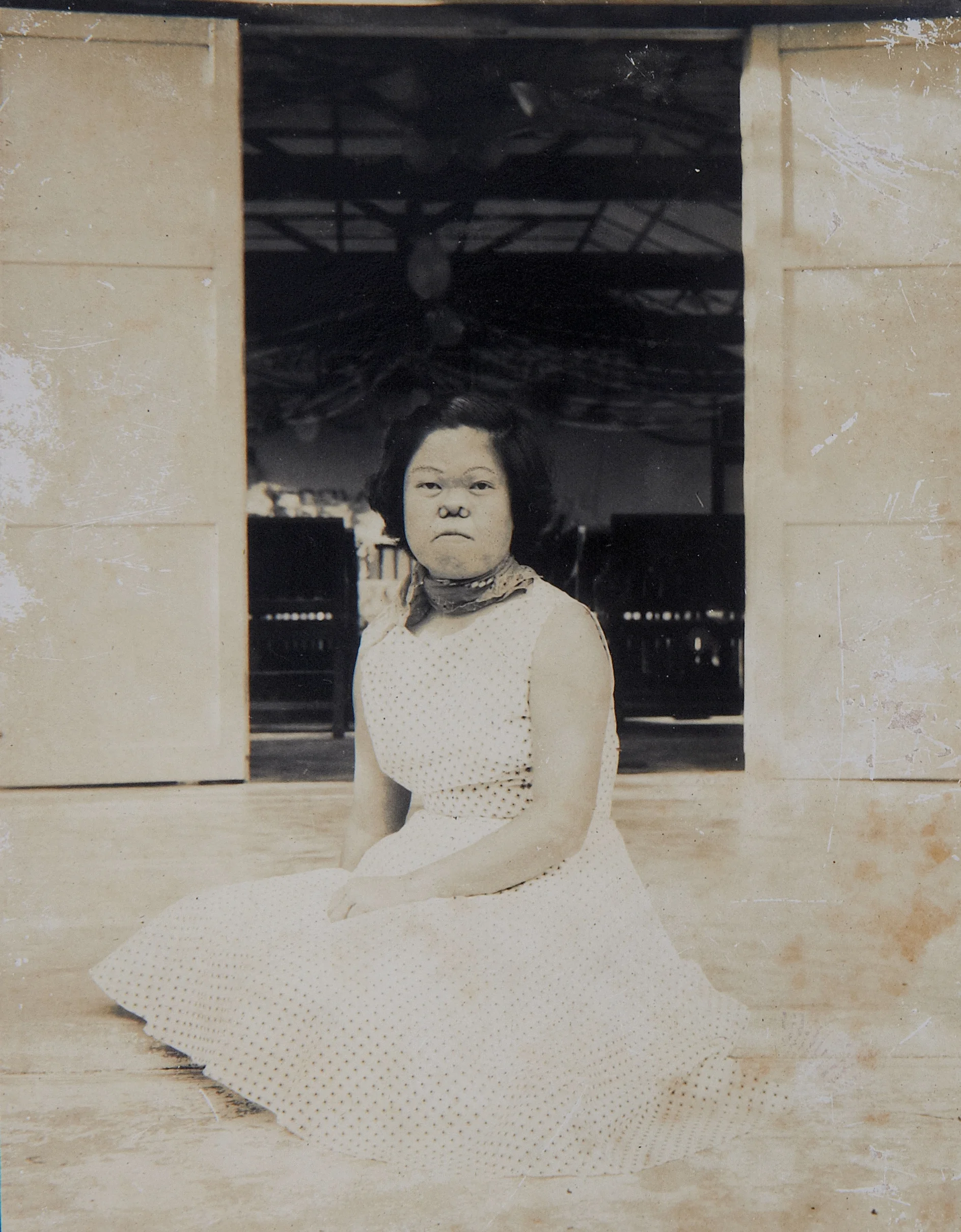 Heng Pak Nang had a collapsed nose from young. (photo courtesy of Heng Pak Nang)