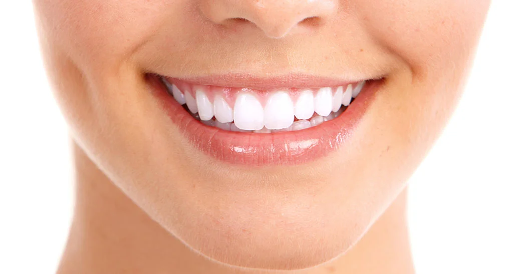 Porcelain veneers vs general cleaning 
