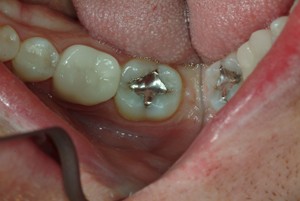 ORIGINAL MERCURY SILVER FILLING