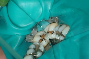 Teeth are isolated w/ a non latex barrier as part of our protocol to reduce or eliminate the exposure to mercury dust and vapors created in removal. Once the amalgam is safely removed from the tooth, the underlying dark decay is evident. This is then removed and disinfected prior to restoration of the tooth.
