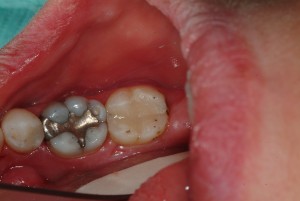 Teeth restored, decay removed, dentin disinfected. Molar with remaining amalgam restoration has ‘crack’ and too large a ‘filling’ so it will receive a porcelain crown.