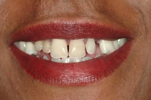 BEFORE: Missing teeth, spaces, and disproportionate sizes between existing teeth are all ‘masked’ with the snap on smile. This treatment does have a more limited application and longevity, but offers an immediate improvement and beautiful smile option.