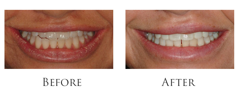 dr-reese-smile-makeover-gallery-1.jpg