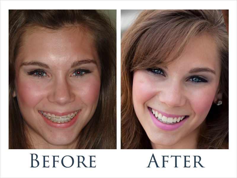 Before and after ceramic braces