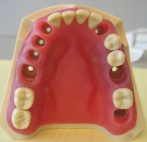 Best Tooth Replacement Options
