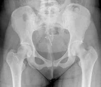 Image of an IUD inside of someone. Not me. I never got a copy of mine. 