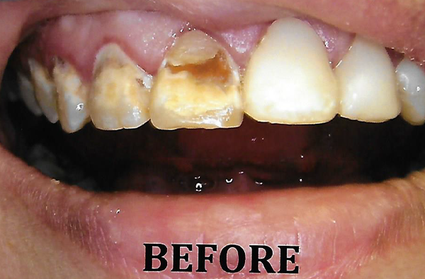 Anterior_Porcelain_Crown_2BEFORE.png