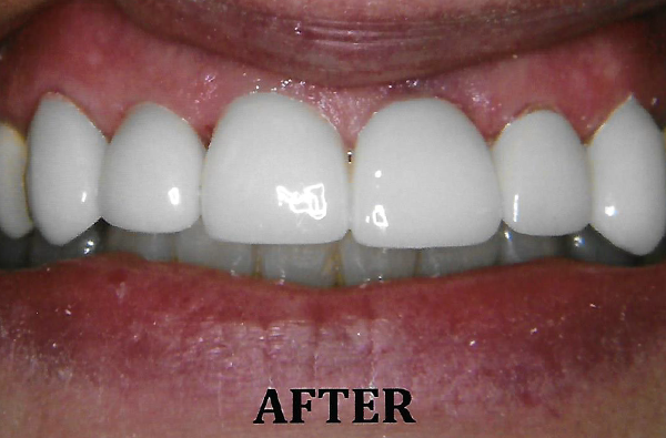 Anterior_Porcelain_Crown_3AFTER.png