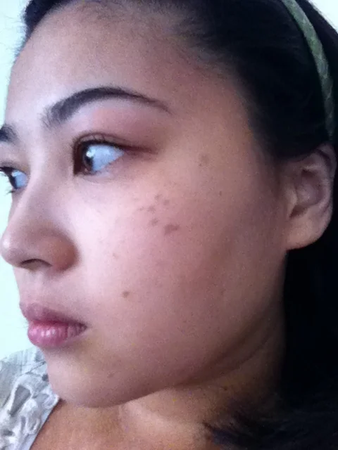 This was taken in 2010 and you can see how dark and prominent my spots were