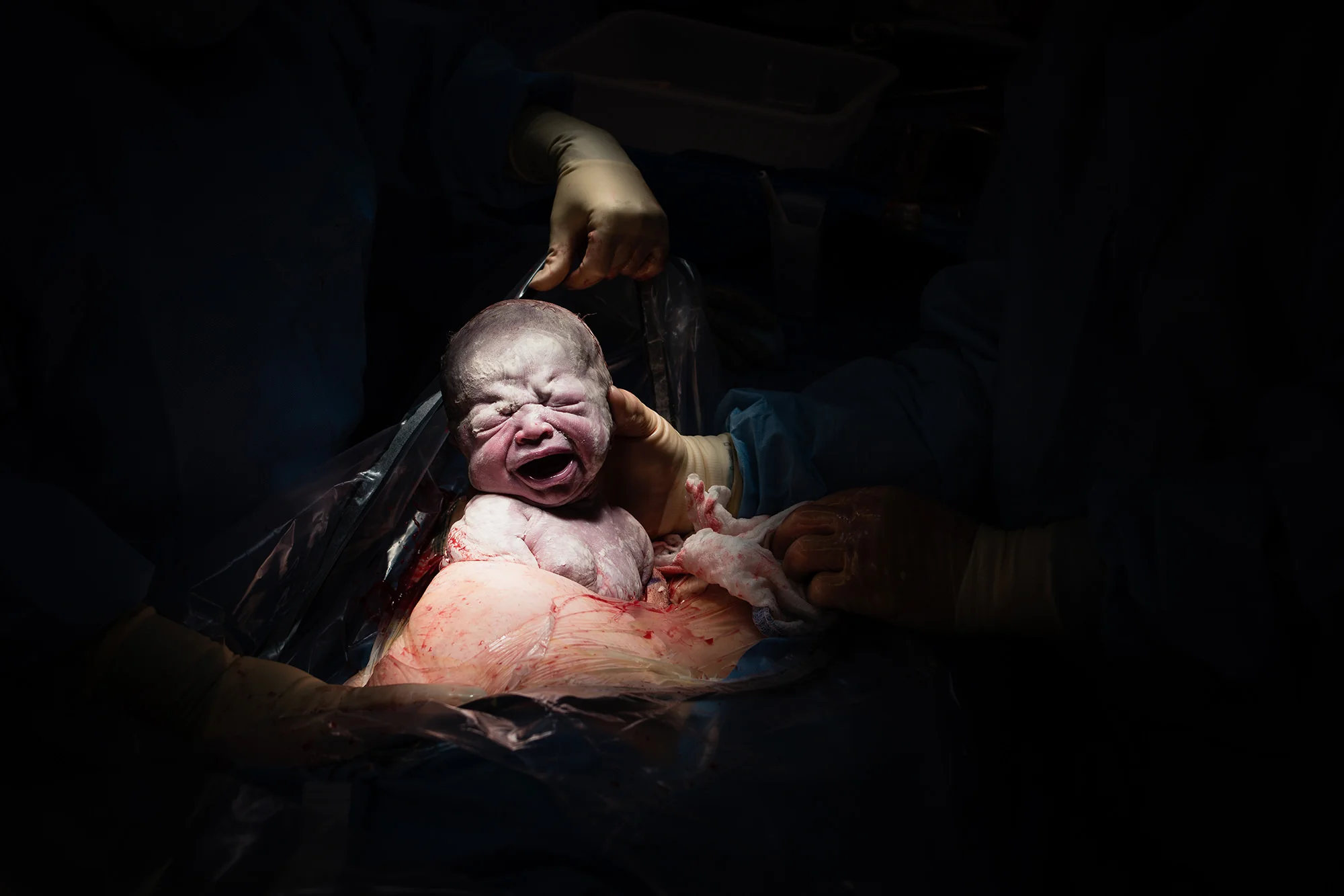 beautiful cesarean birth (c-section)