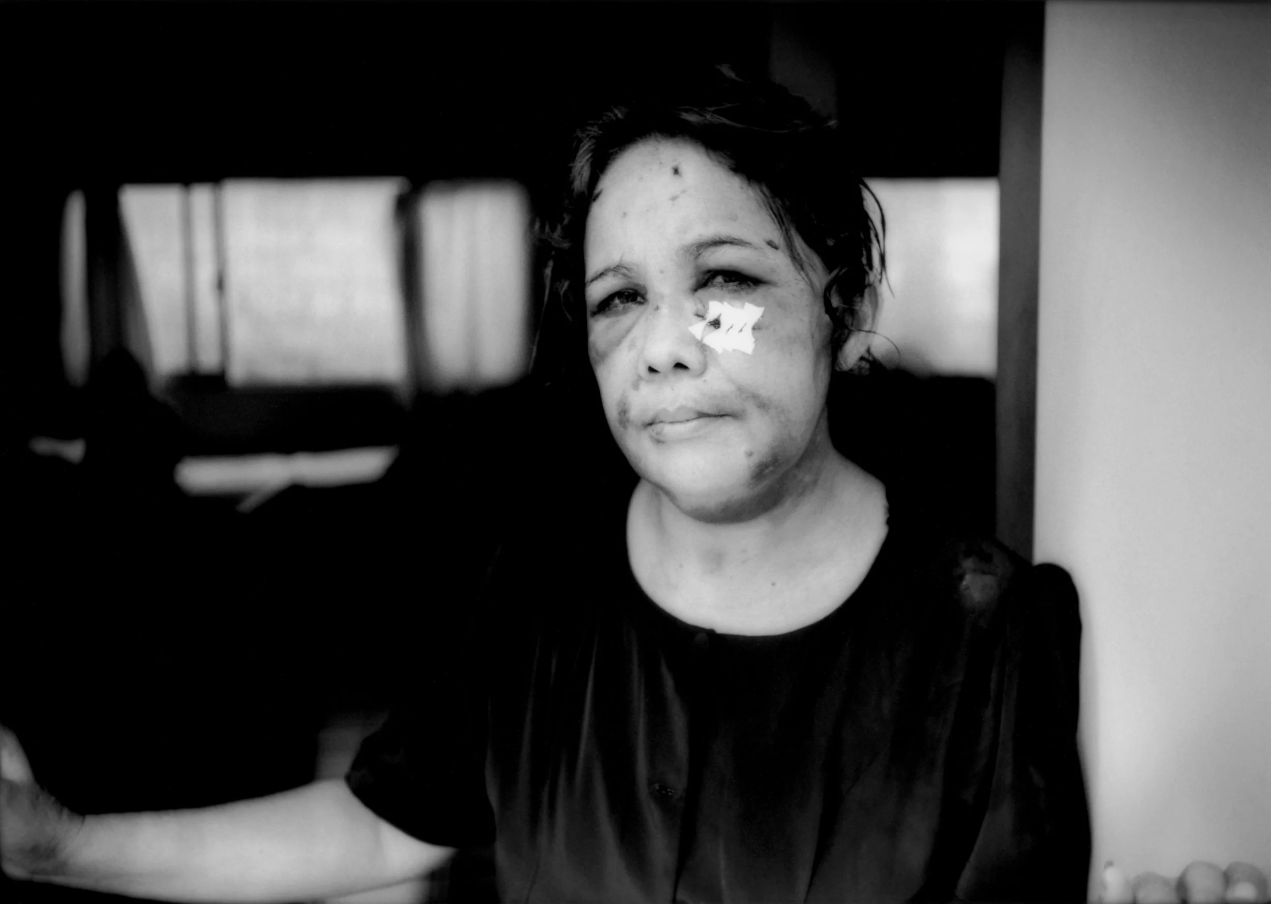 Janeth Aminta Munoz of Honduras was robbed and beaten at a market between the southern border city of Tapachula, Chiapas and the border when she reached into her bag by several men who nearly killed her. She was taken in by the Shelter of Jesus the Good Shepherd, which nurtures migrants injured on the journey north through Mexico, Tapachula, Chiapas, Mexico. 2008