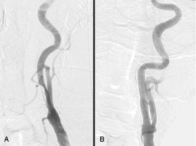 Angiogram Cath Image