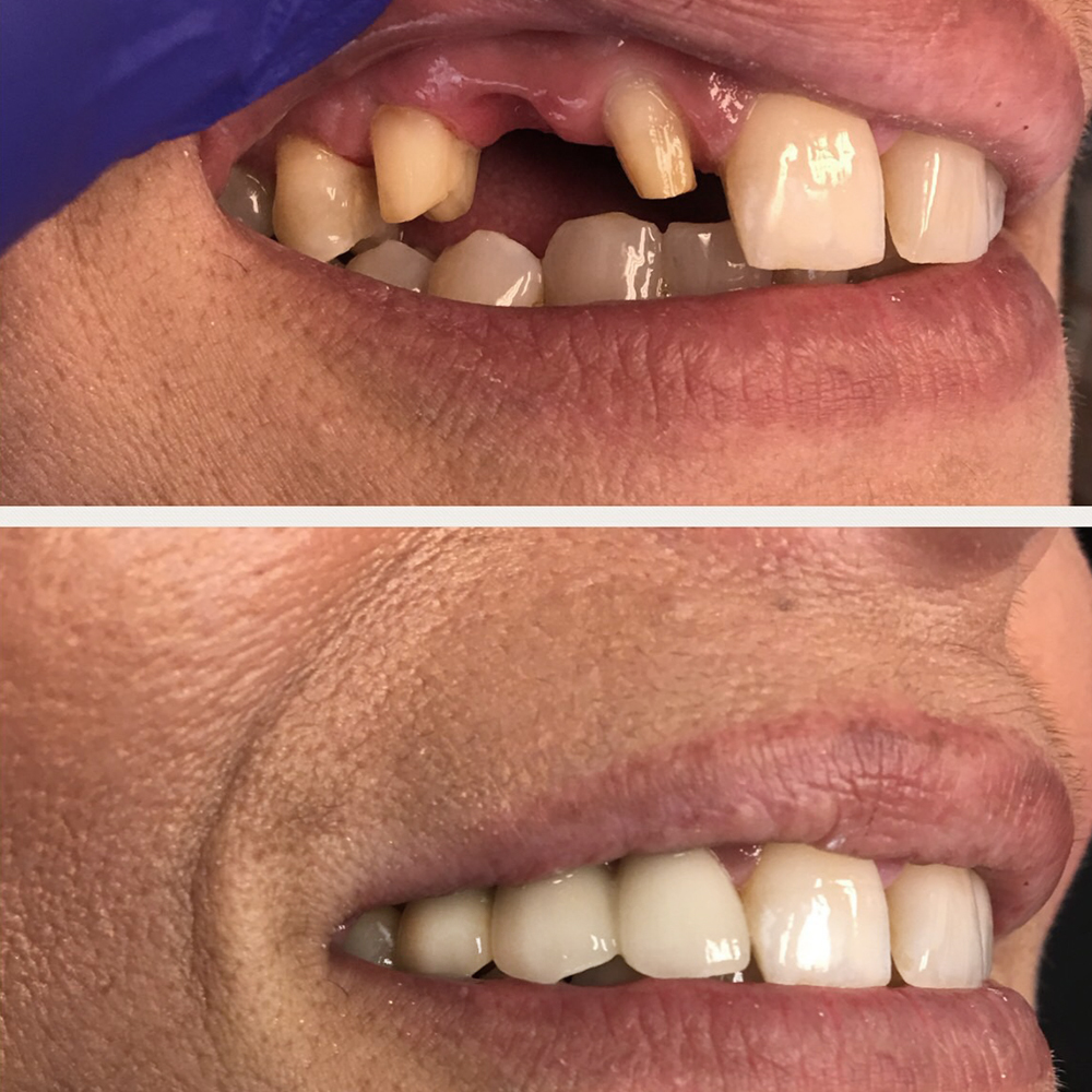 bridge teeth before and after.jpg