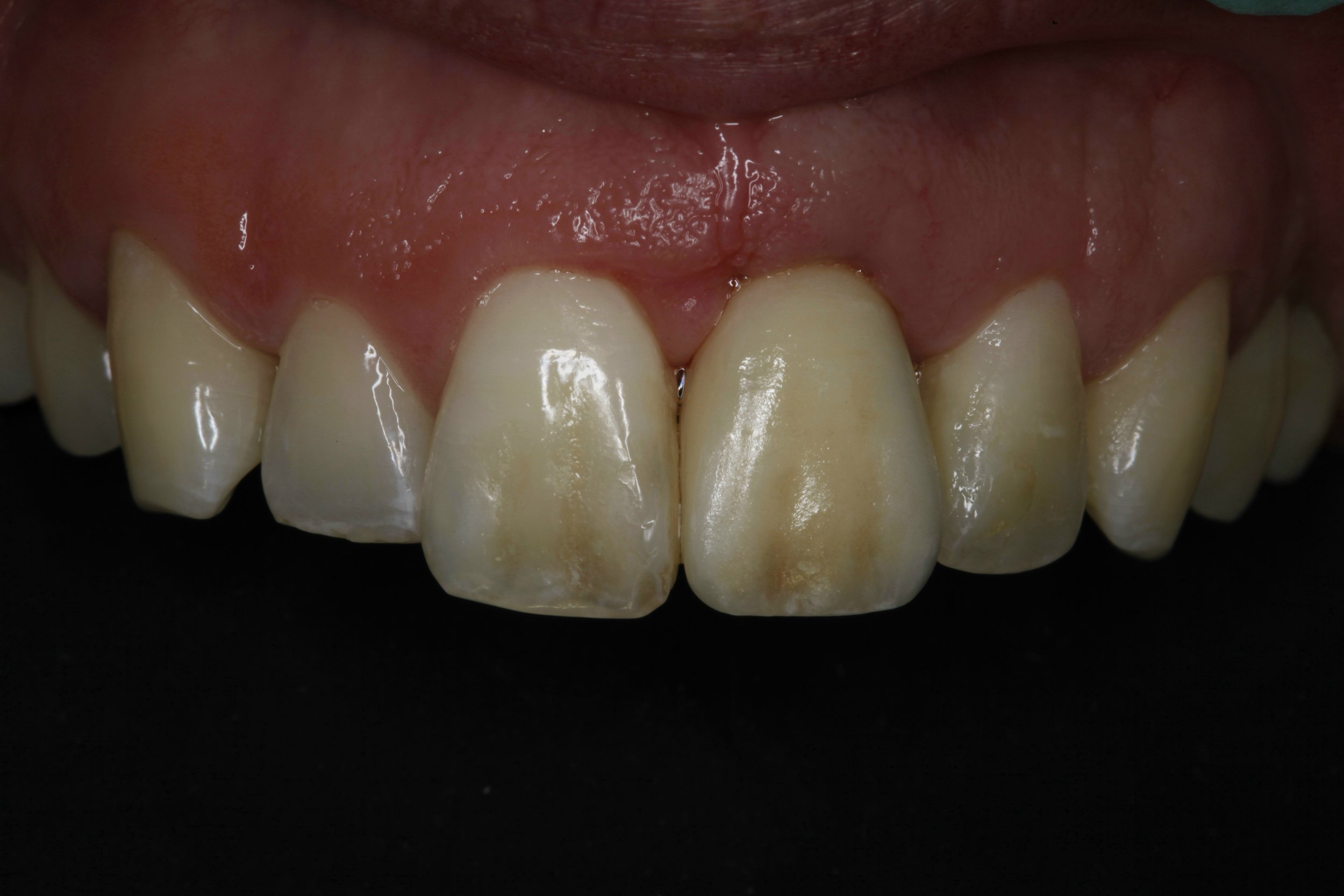 Implant Dentistry - after