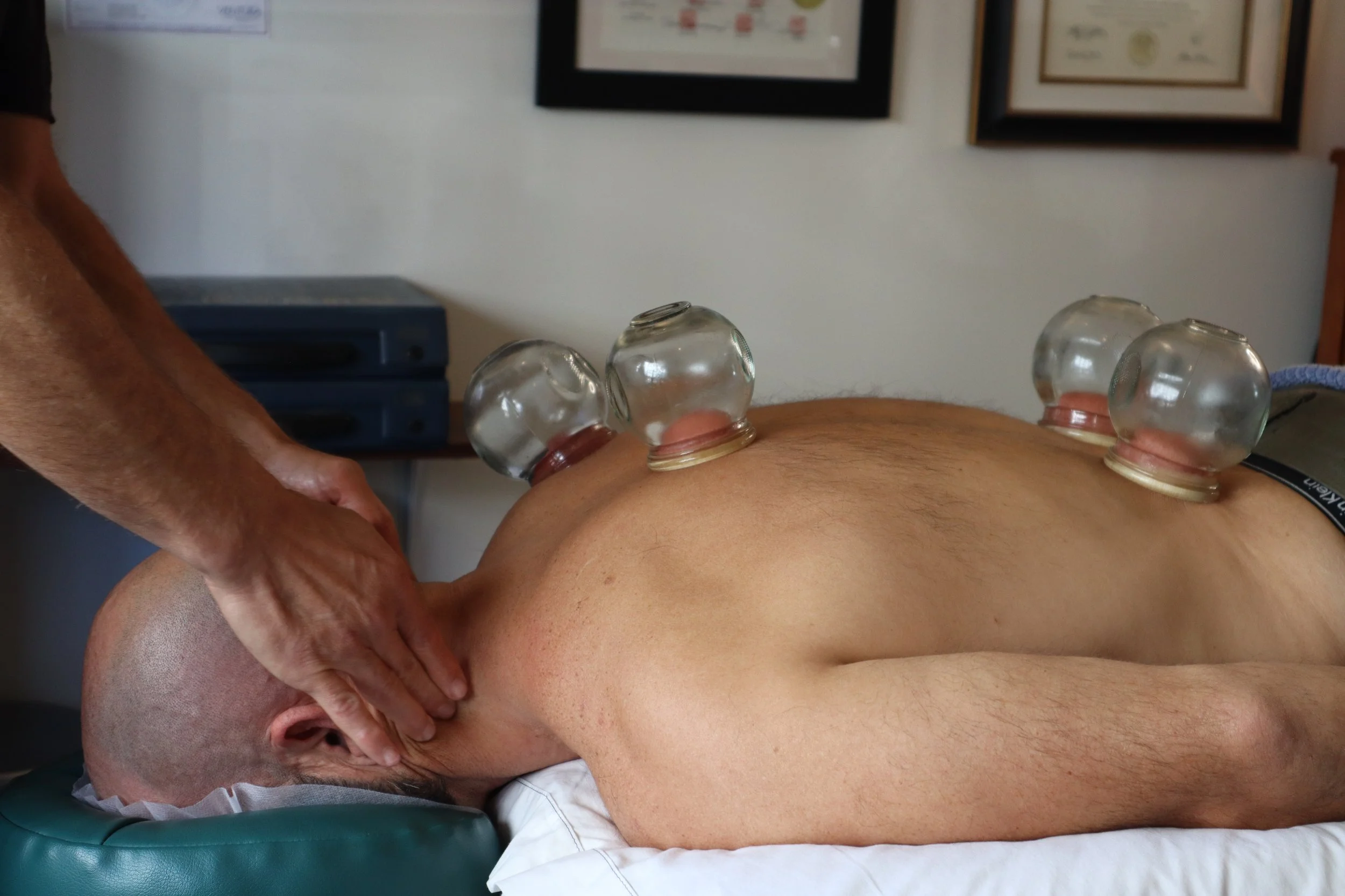A person receiving cupping therapy on their back with four glass cups. The individual is lying face down on a treatment table, with a healthcare professional applying therapy. The setting appears to be a medical or therapy room with framed certificates on the wall.