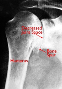 Shoulder arthritis/Replacement