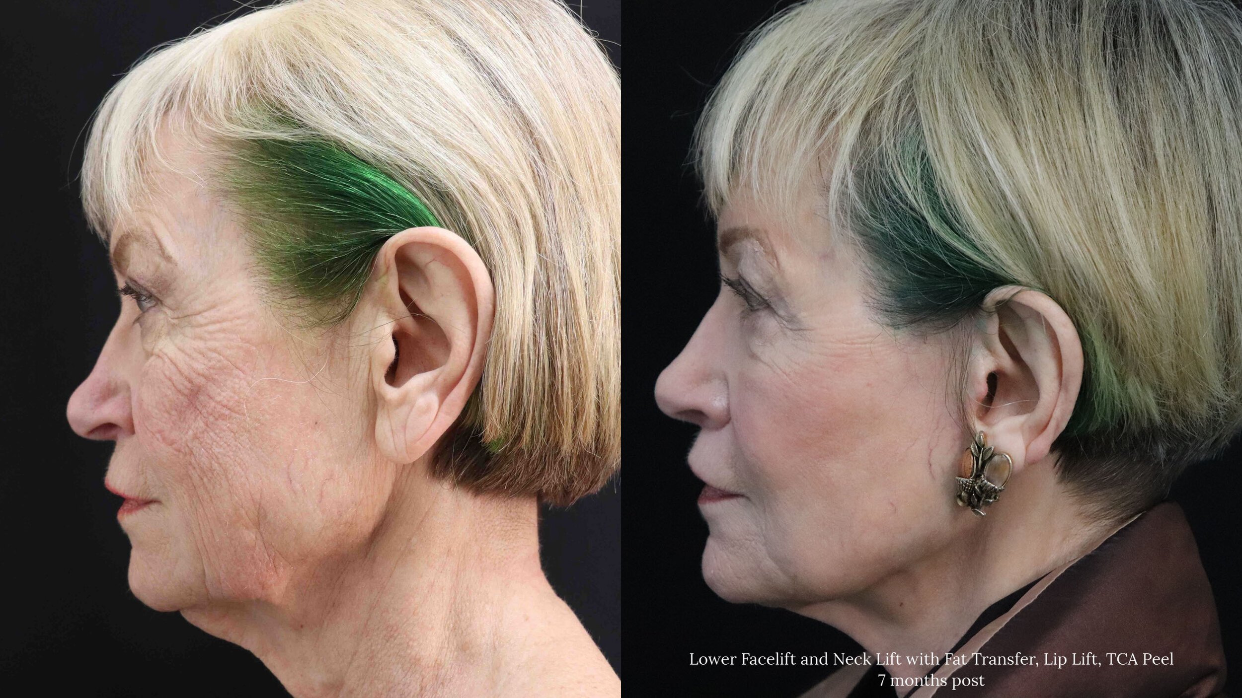 Lower+Face+and+Neck+Lift_3.3.jpg