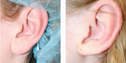 earlobe_repair_reduction_4.jpg