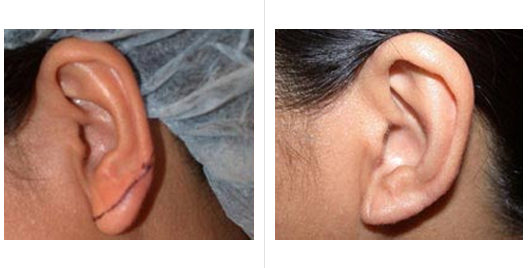 earlobe_repair_reduction_5.jpg