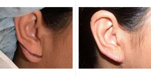Ear Lobe Repair Surgery, Ear Lobe Repair Treatment - Sakhiya Skin Clinic