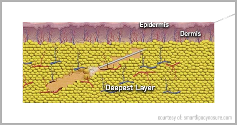 Video: Liposuction vs. Liposculpture SF Bay Area