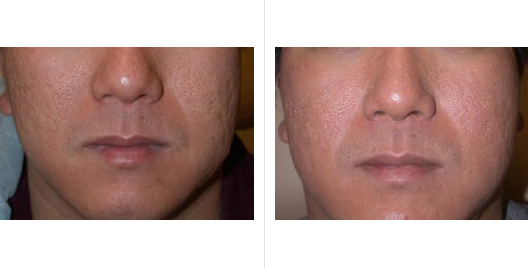 laser skin resurfacing_ba_1.jpg