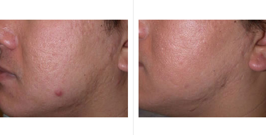 laser skin resurfacing_ba_2.jpg