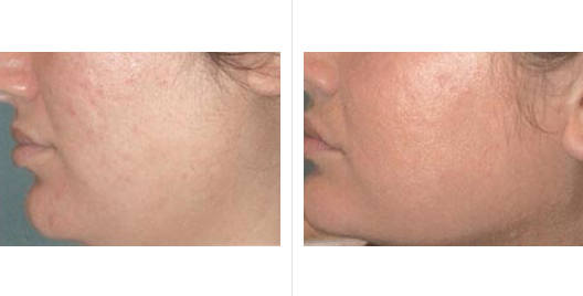 laser skin resurfacing_ba_4.jpg