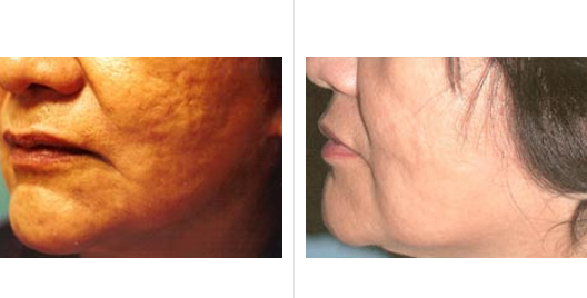 laser skin resurfacing_ba_5.jpg